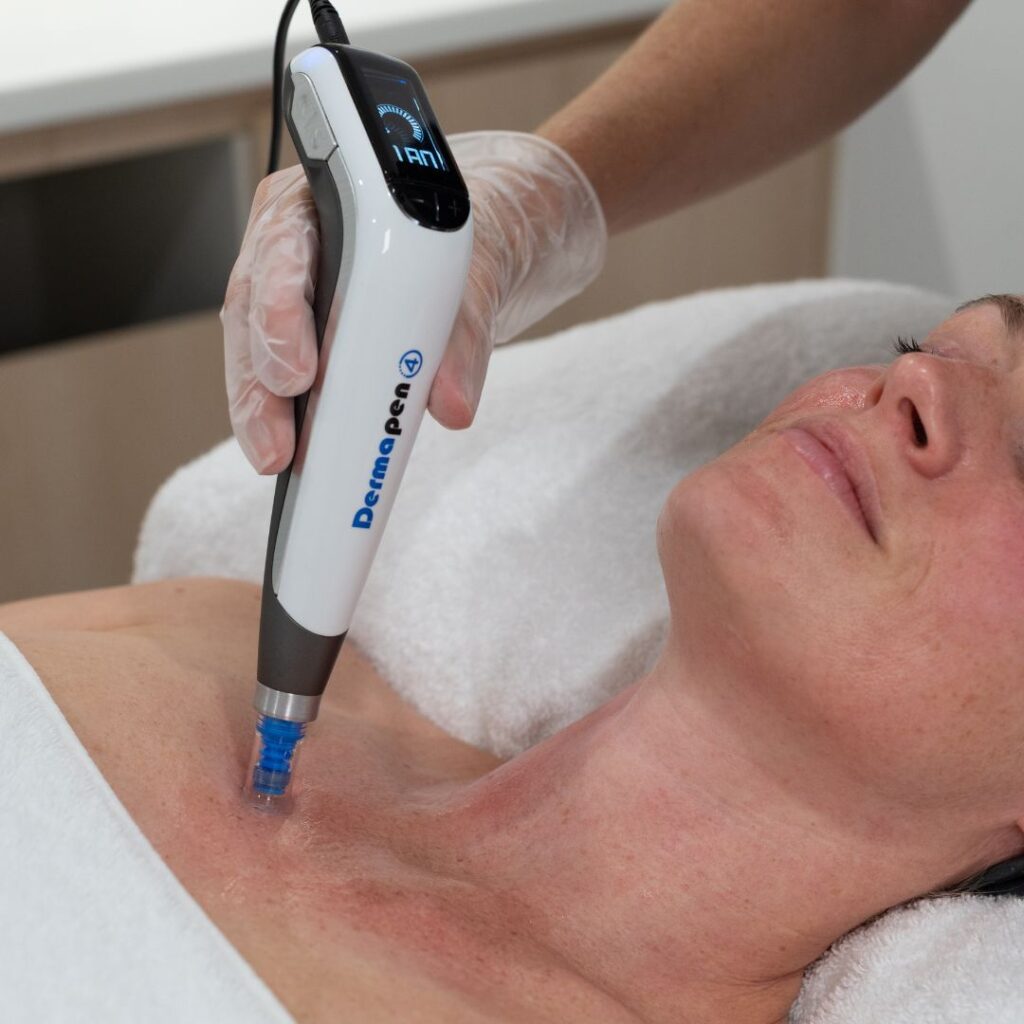 woman receiving a Face, Neck & Decolletage skin needling treatment