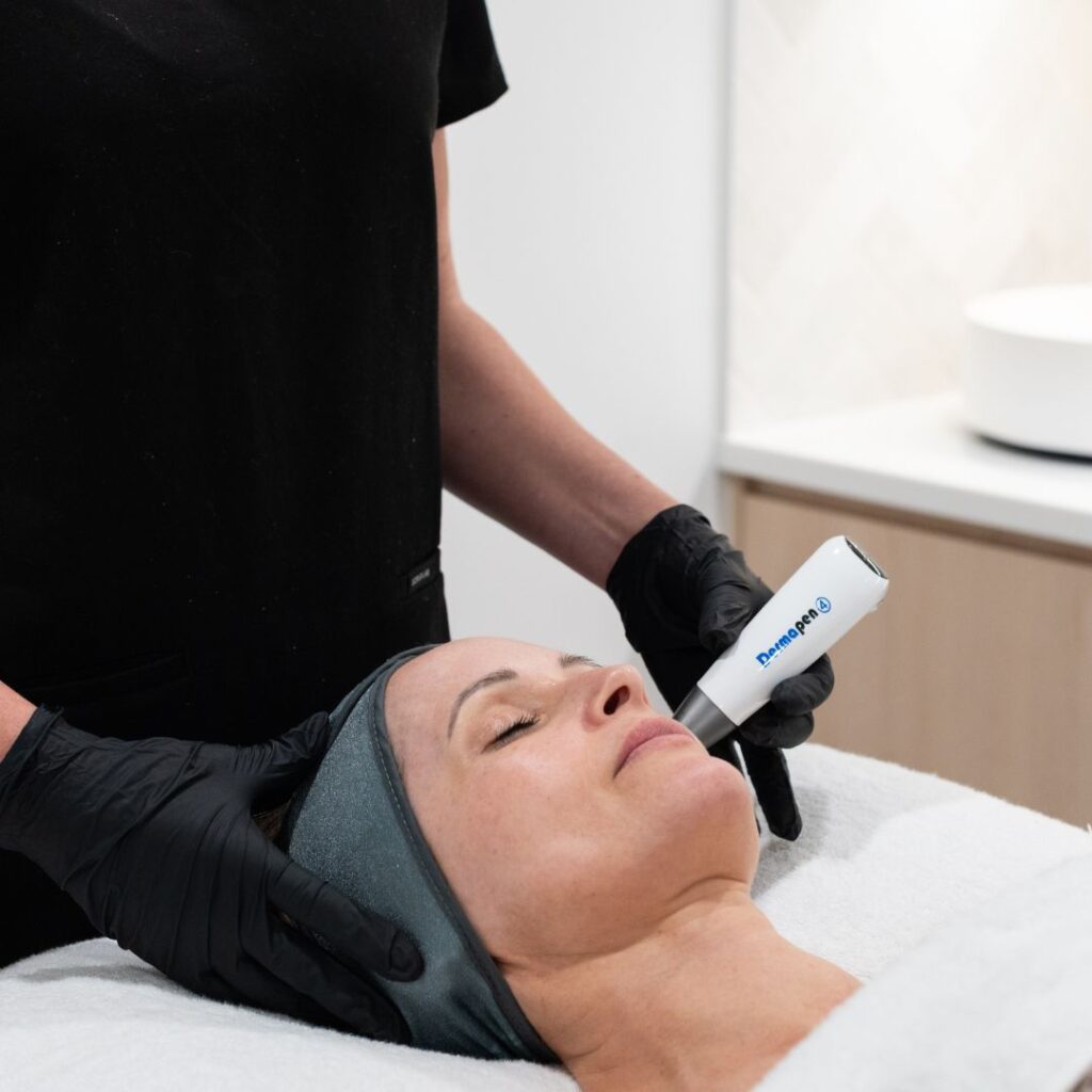 Skin Needling Full Face