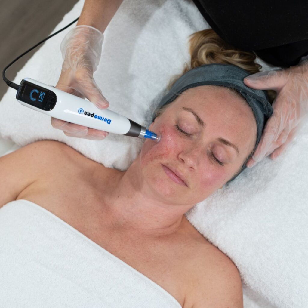 woman receiving a Skin Needling Full Face treatment