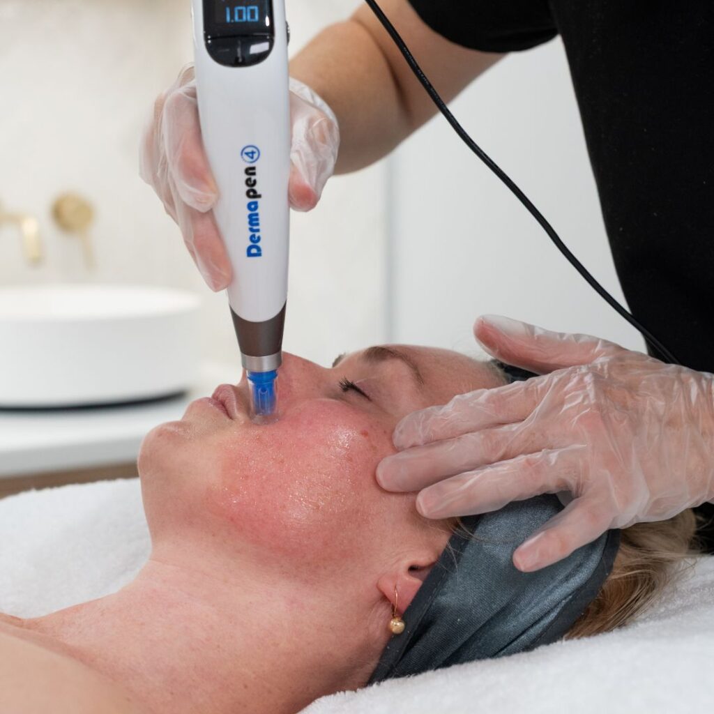 Exo Booster Pro Needling treatment