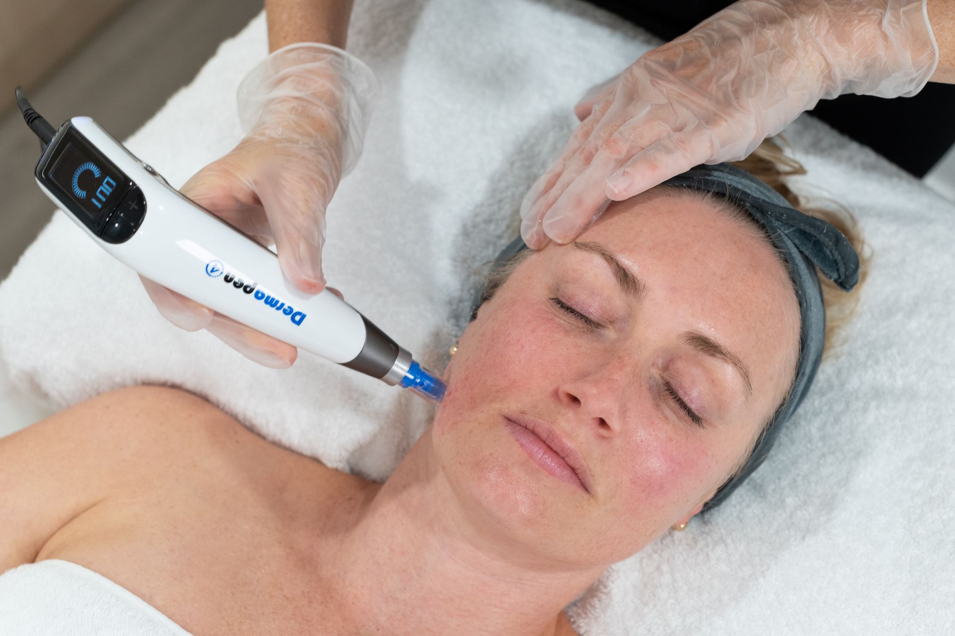 Skin needling